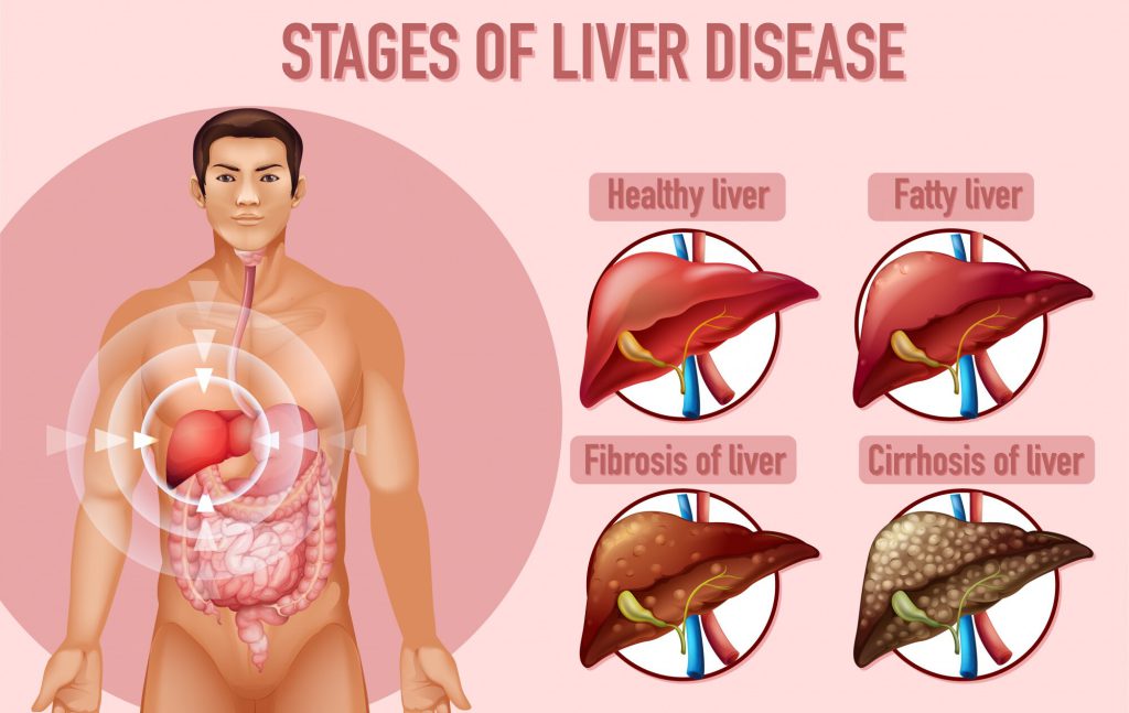 alcoholic liver diseases, alcoholic hepatitis, liver cancer